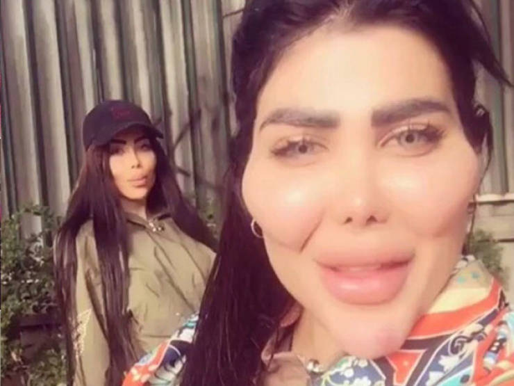 When Plastic Surgery Goes Too Far