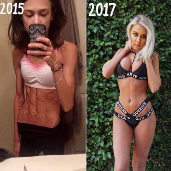Fighting Anorexia With Beauty