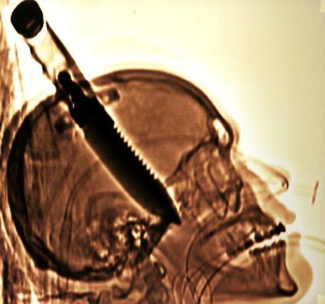 The Most Bizarre Items That Have Gotten Stuck in People’s Bodies