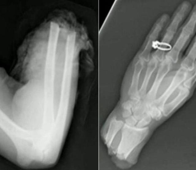 The Most Bizarre Items That Have Gotten Stuck in People’s Bodies