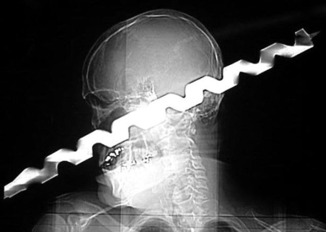 The Most Bizarre Items That Have Gotten Stuck in People’s Bodies