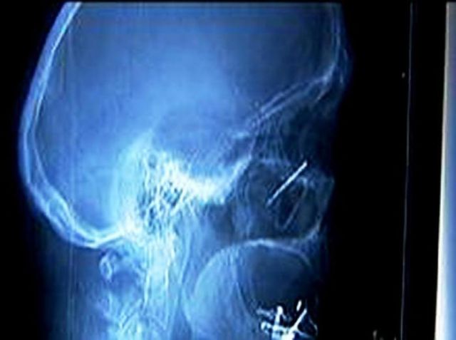 The Most Bizarre Items That Have Gotten Stuck in People’s Bodies