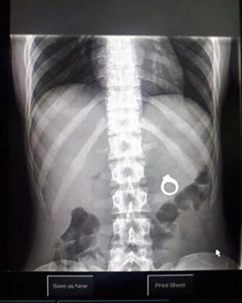 The Most Bizarre Items That Have Gotten Stuck in People’s Bodies