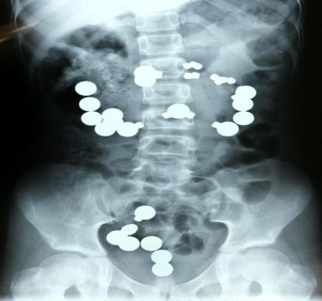 The Most Bizarre Items That Have Gotten Stuck in People’s Bodies